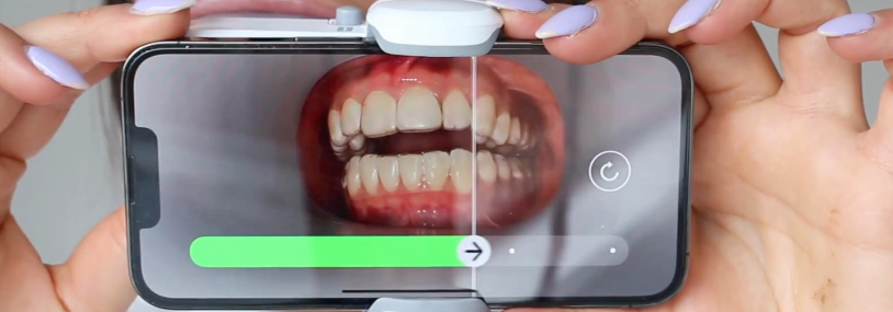 Remote Dental Monitoring: Conveniently Monitor Your Orthodontic Treatment