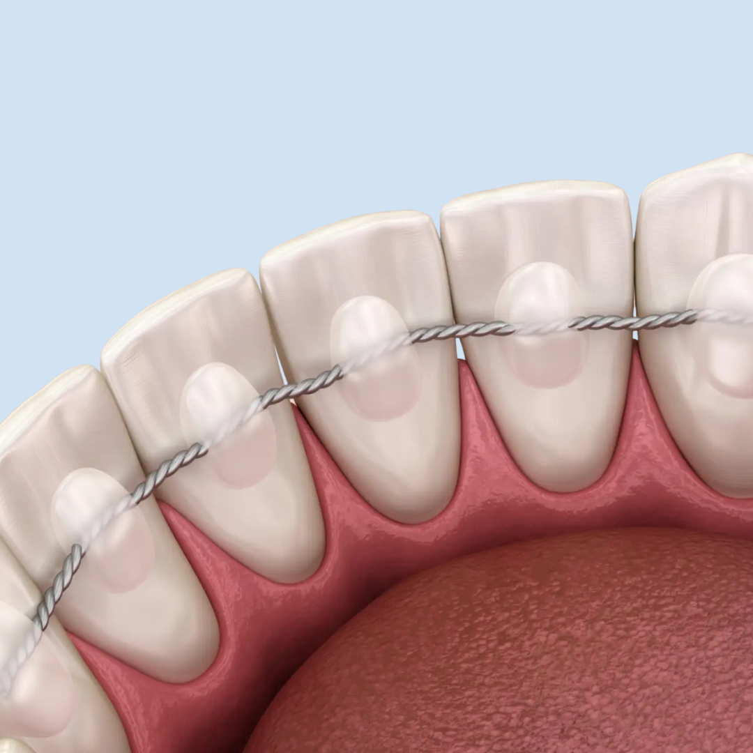 Lingual Bonded Retainers