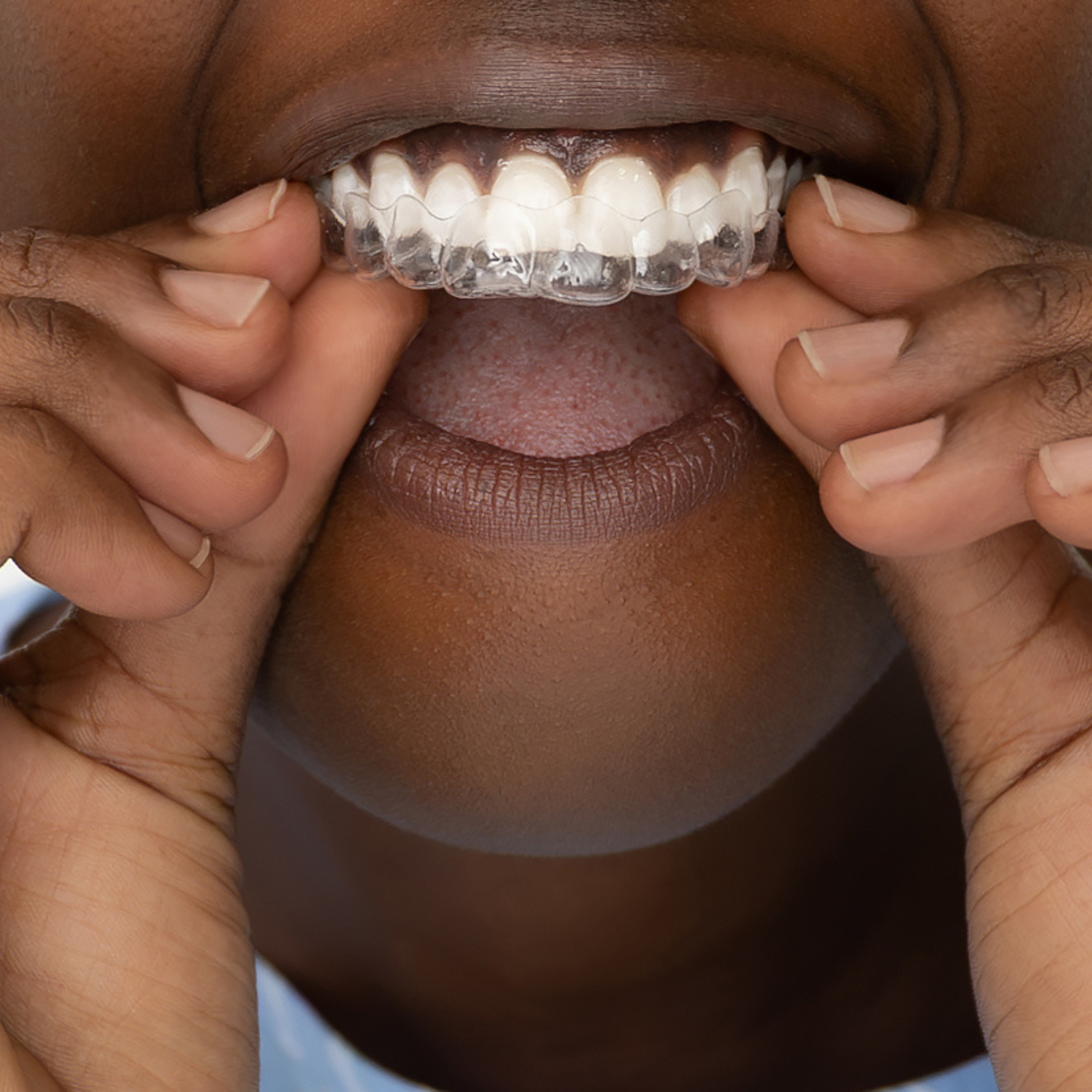 Post Treatment Retainers