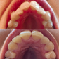 Bitesoft Co Results From Clear Aligners